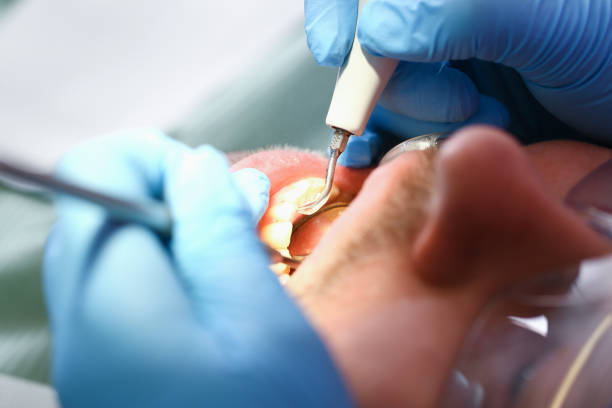 Best Chipped Tooth Repair Near Me  in Clear Lake, IA